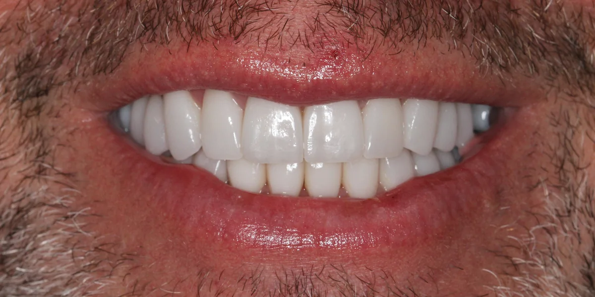 Featured patient after complete veneer restoration close-up smile result