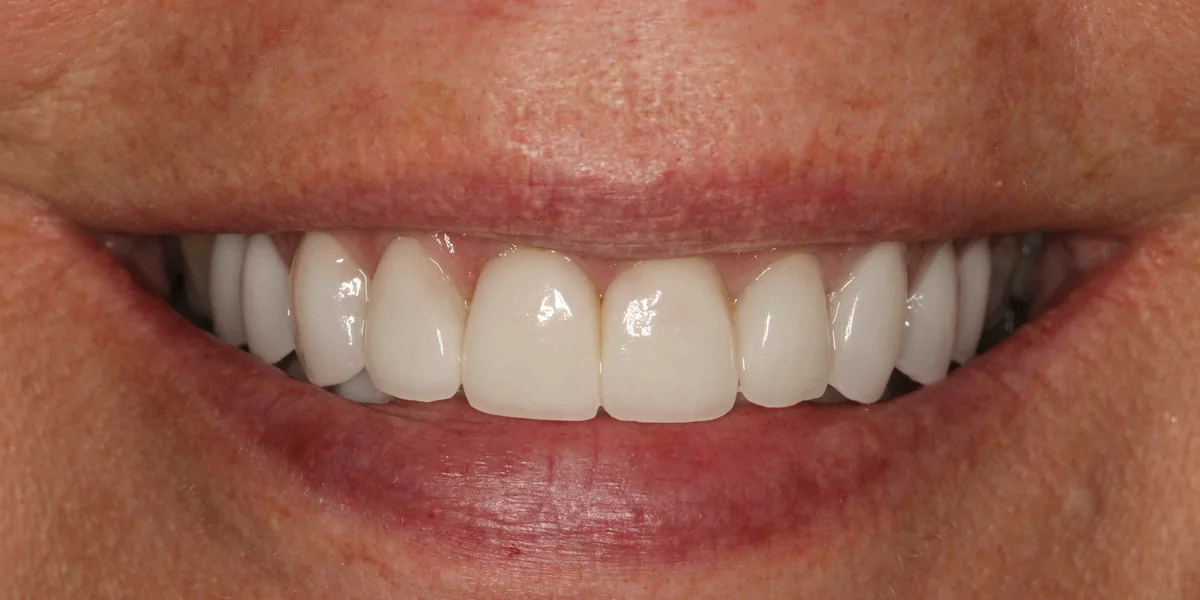 Featured patient before porcelain veneers and smile design close-up smile condition