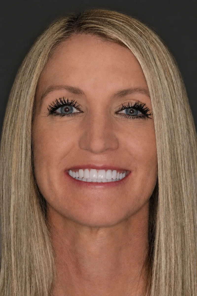 Featured patient after full arch veneers and bite restoration full smile portrait